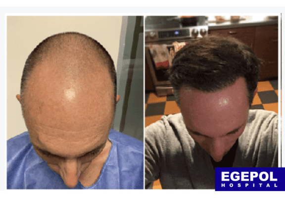 HairTransplant3