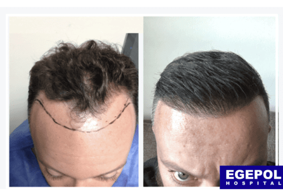 HairTransplant4