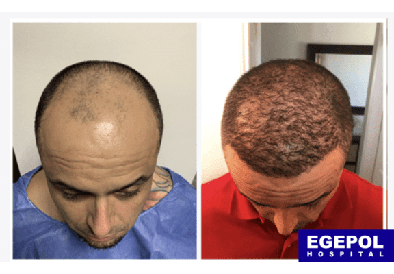 HairTransplant5