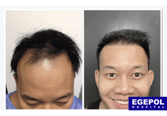 HairTransplant6